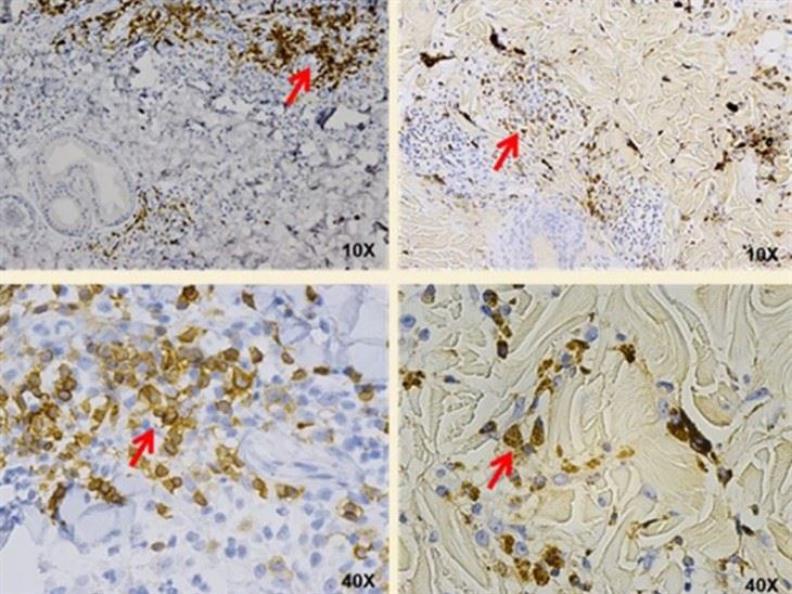 Seinkað ofnæmi (DTH) Nonhuman Primates Disease Model